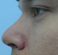 Ластика носа после операции. Клиника Эклан.